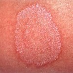 Renaissance Dermatology Specialist Clinic - Tinea corporis is a superficial  fungal infection of the skin that affects the body and limbs. It is  commonly called 'ringworm' as it presents with characteristic ring-shaped